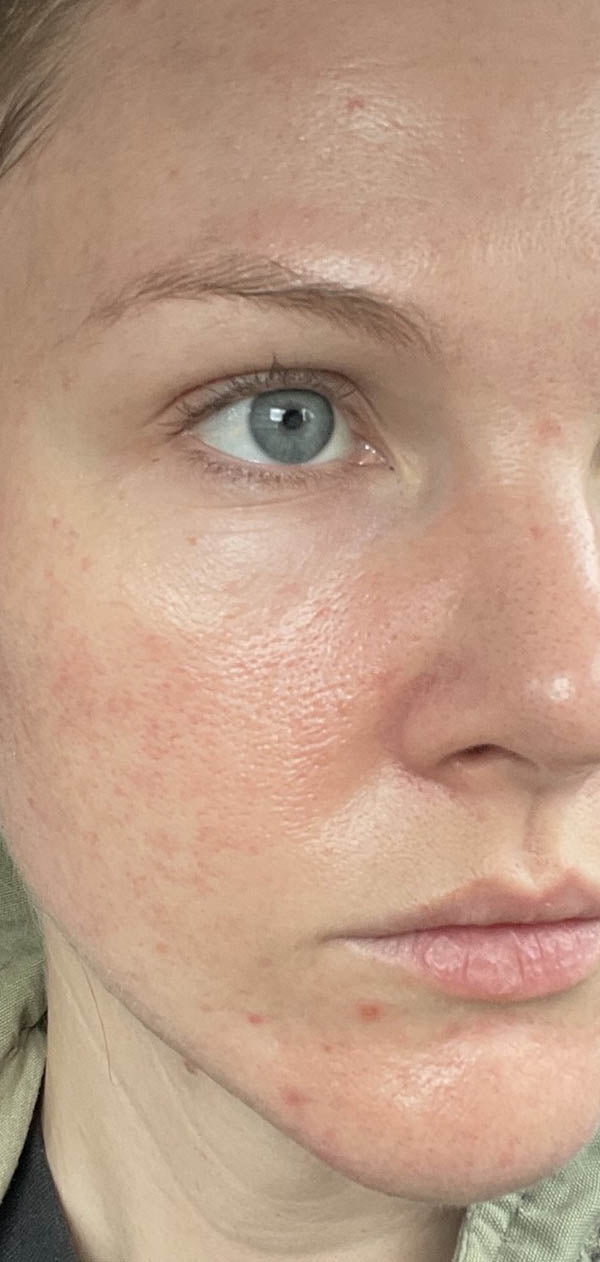Fair skinned woman with redness reduced - after