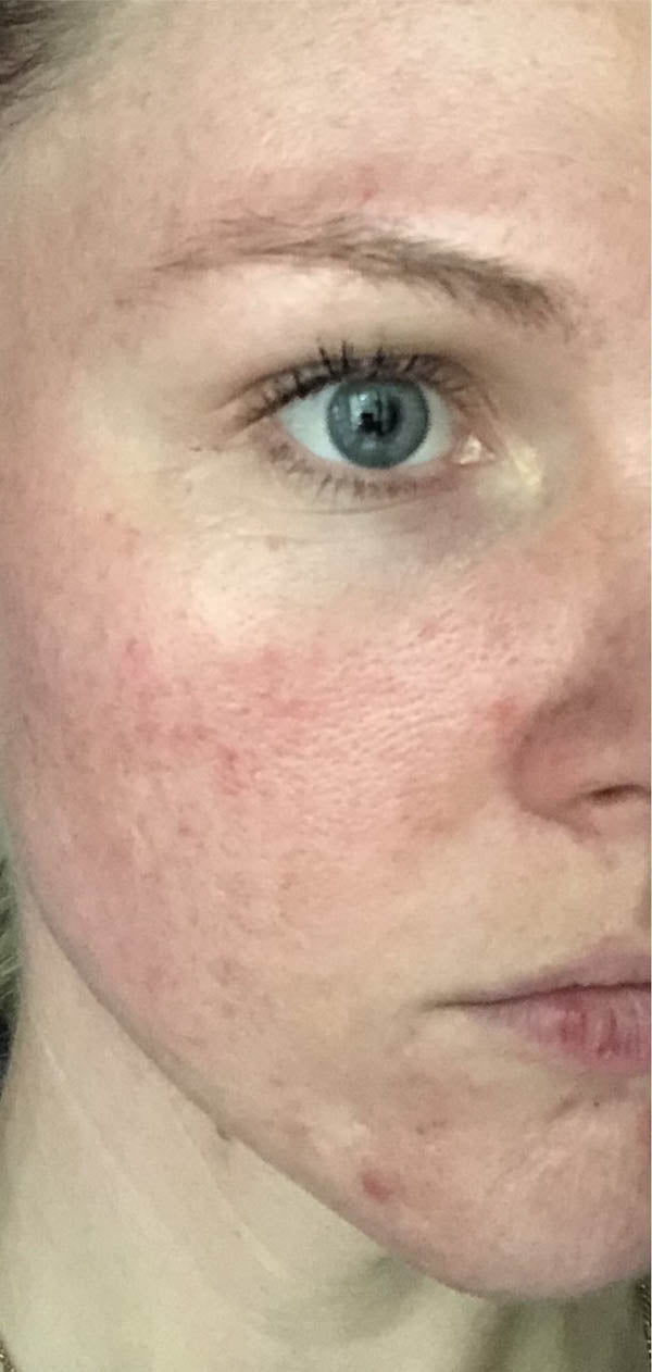 Fair skinned woman with redness on her face - before