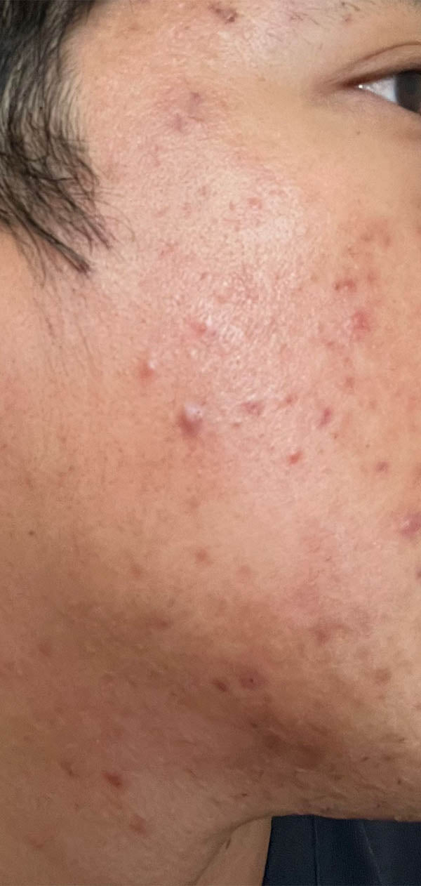 Face with diminished acne and redness - after
