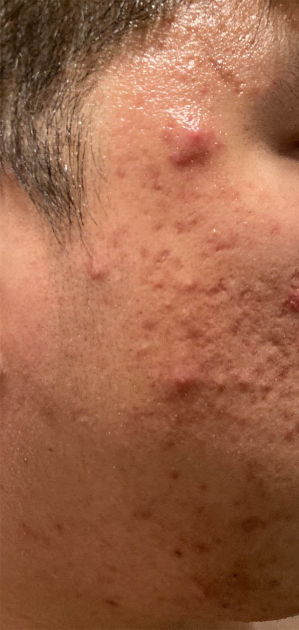 close up face with acne and redness - before