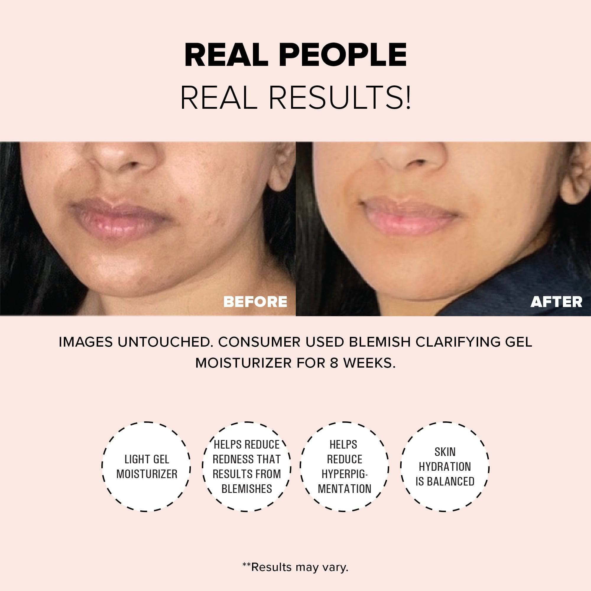 Real people, real results before and after using Nudeskin Blemish Clarifying Gel Moisturizer 