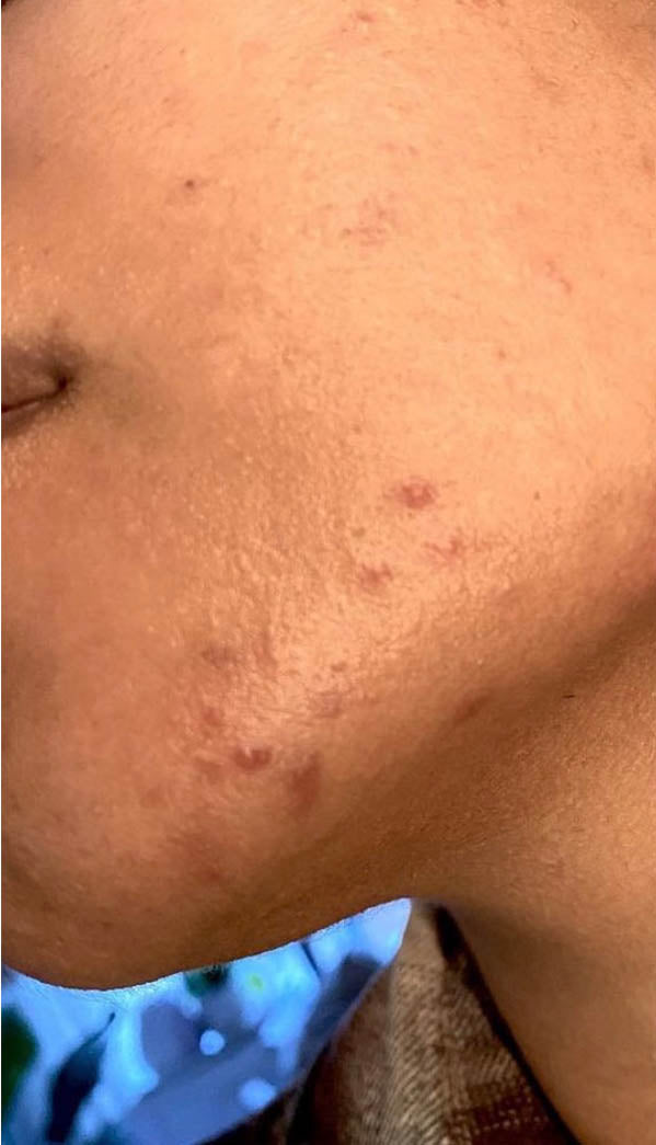 close up face with acne scars 