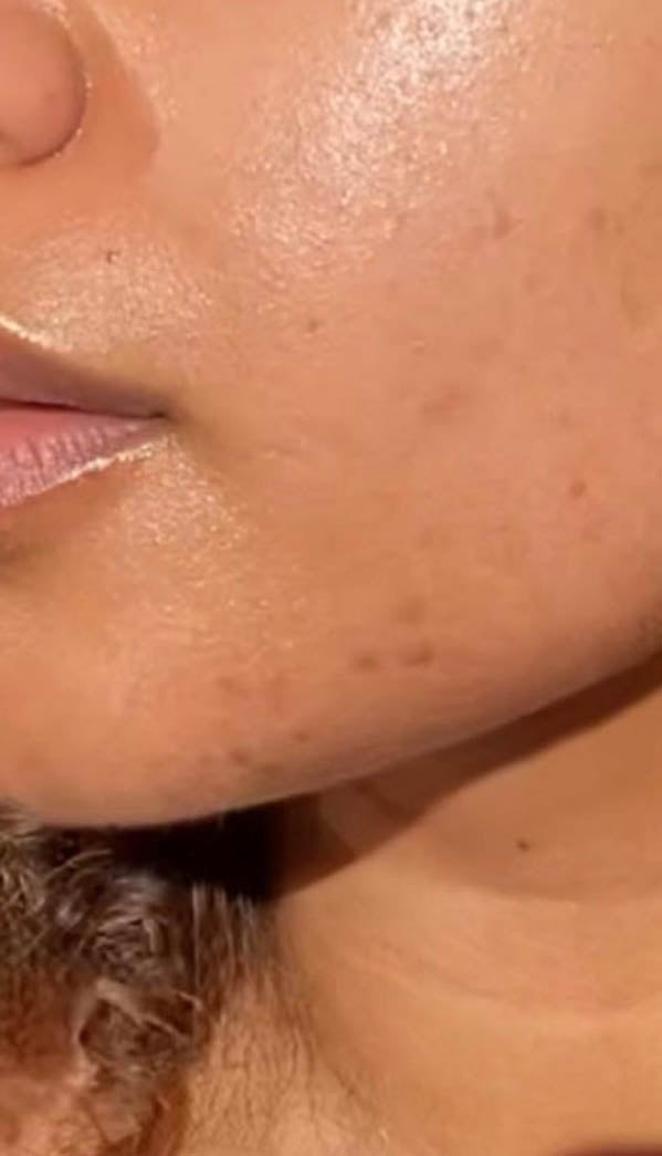 close up face with acne scars after using nudeskin products