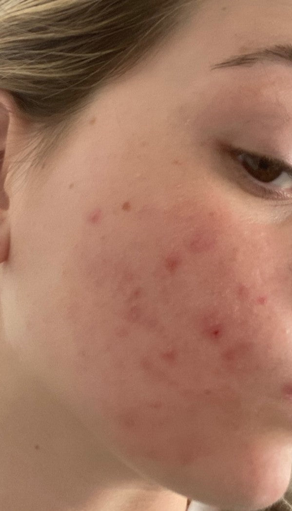 close up skin with acne, before nudeskin products