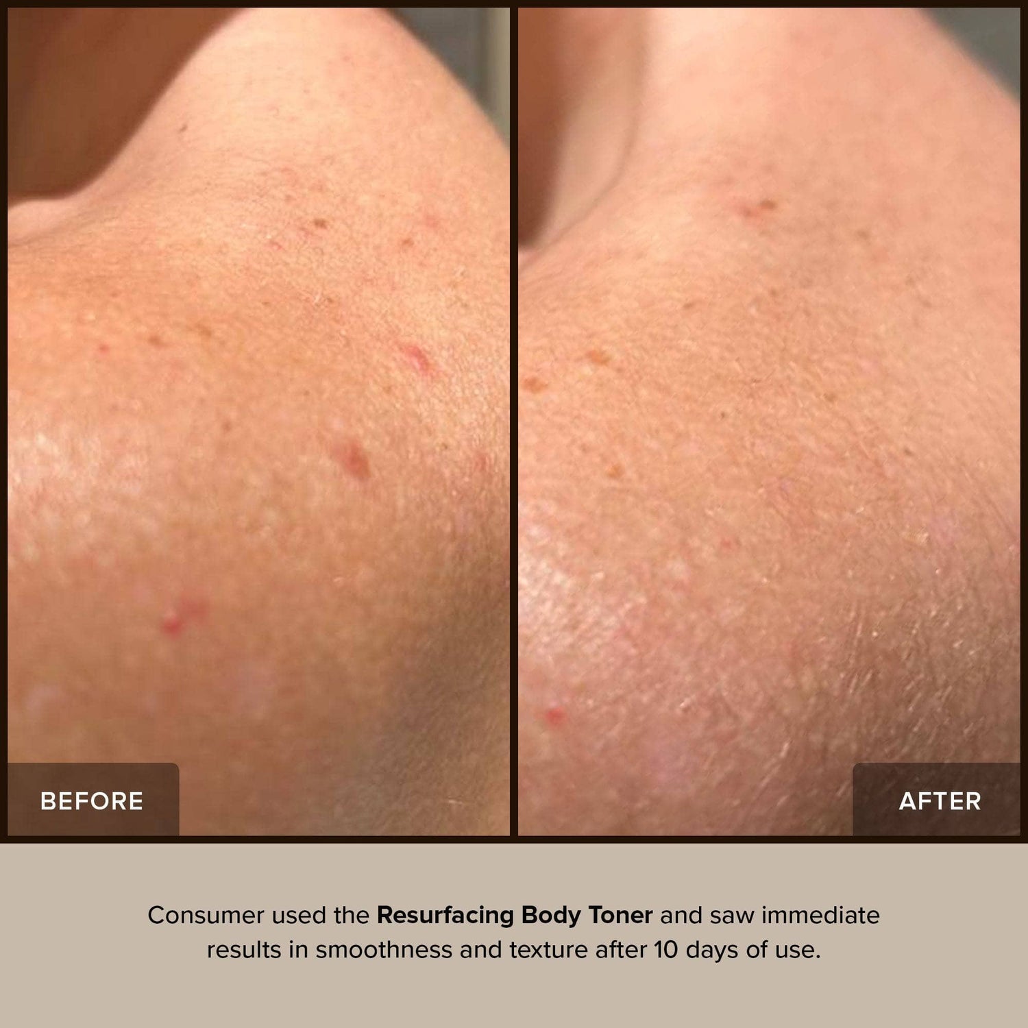 Before and after skin after using Resurfacing Body Toner for 10 days